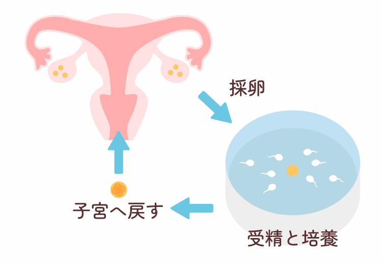 体外受精・胚移植について