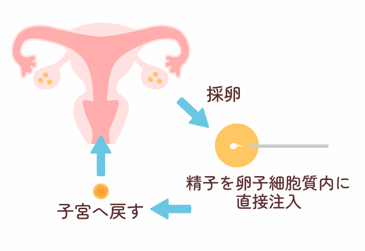 顕微授精について