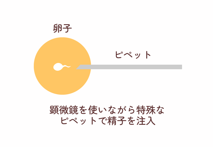 顕微授精の手順